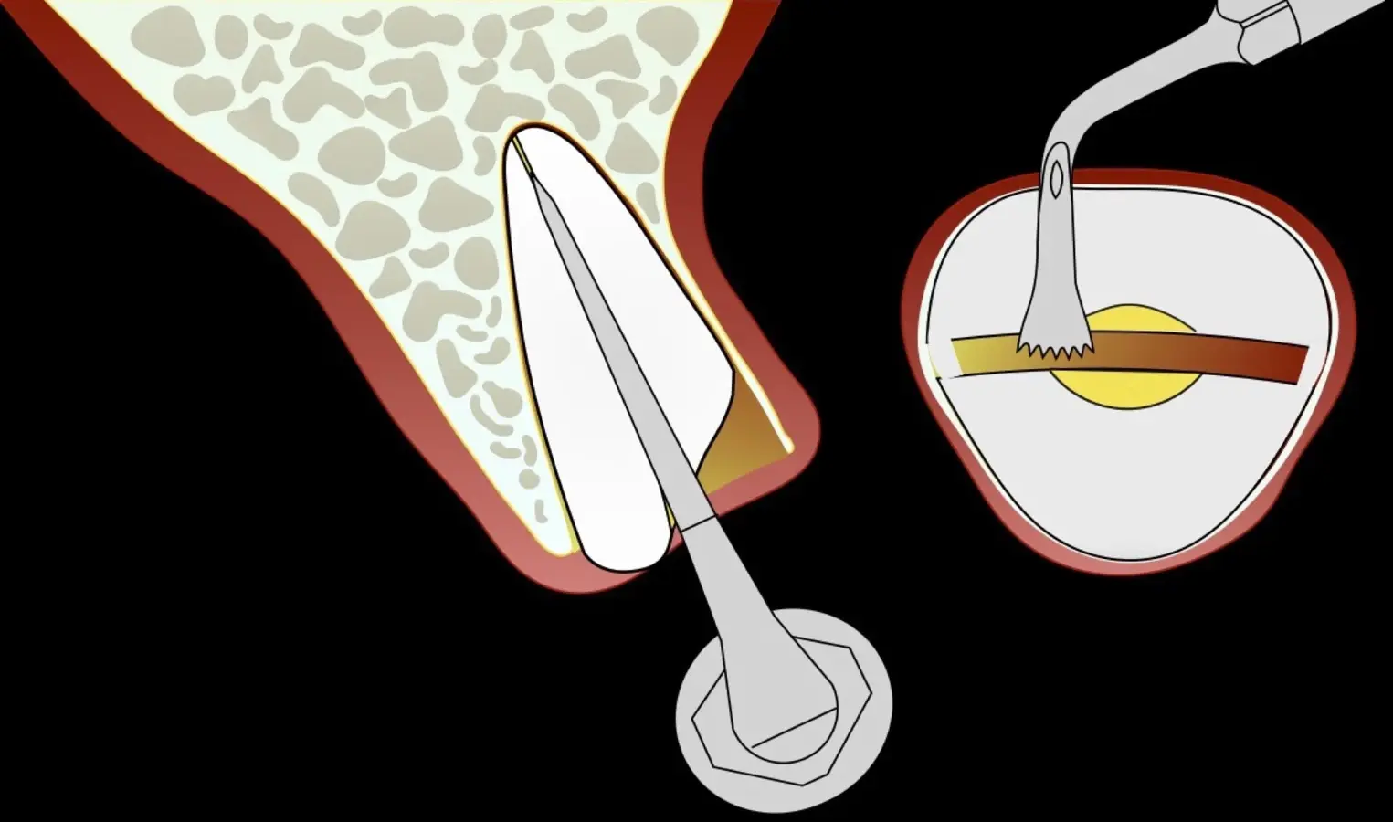 Completion of the odontosection using a piezoelectric instrument (B1 by W&H). Completion of the odontosection using a piezoelectric instrument (B1 by W&H).