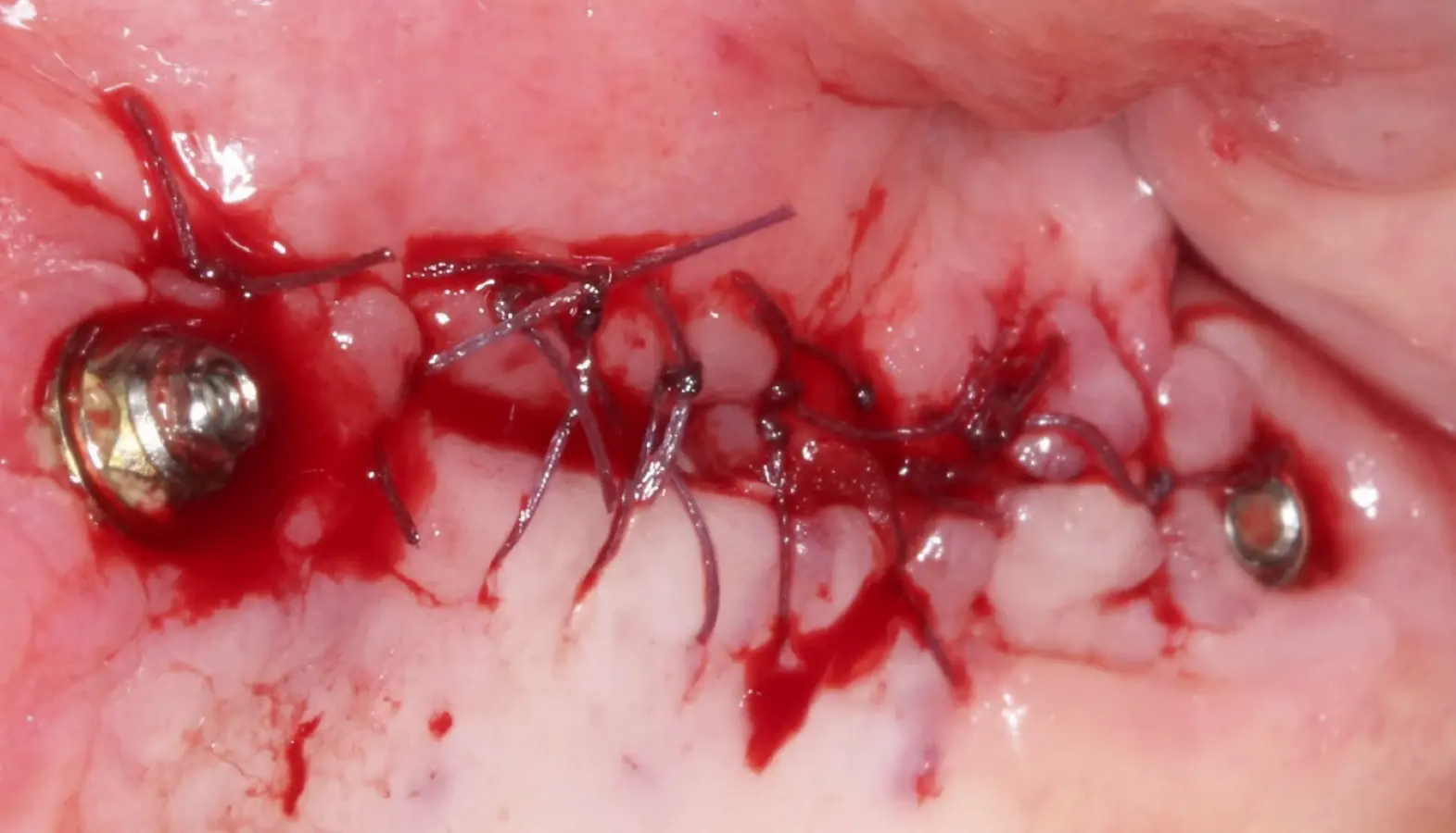 Afrontamiento de colgajo y sutura. Afrontamiento de colgajo y sutura.