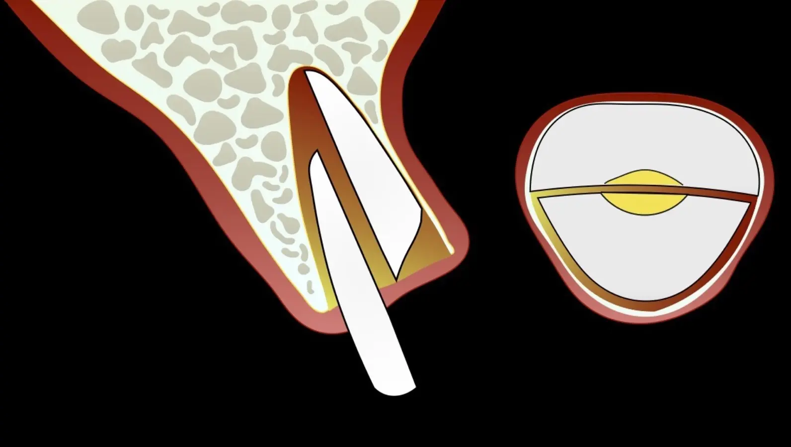 Avulsion of the palatal fragment Avulsion of the palatal fragment