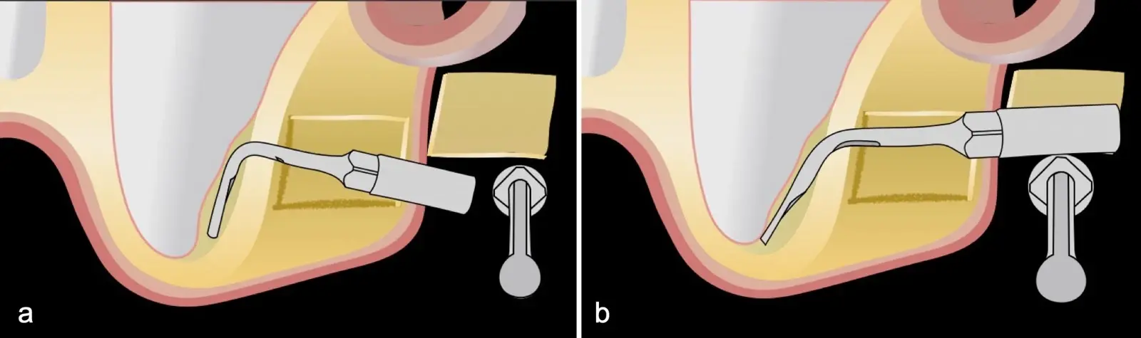 Desplazamiento de la membrana con curetas de piezoeléctrico Desplazamiento de la membrana con curetas de piezoeléctrico