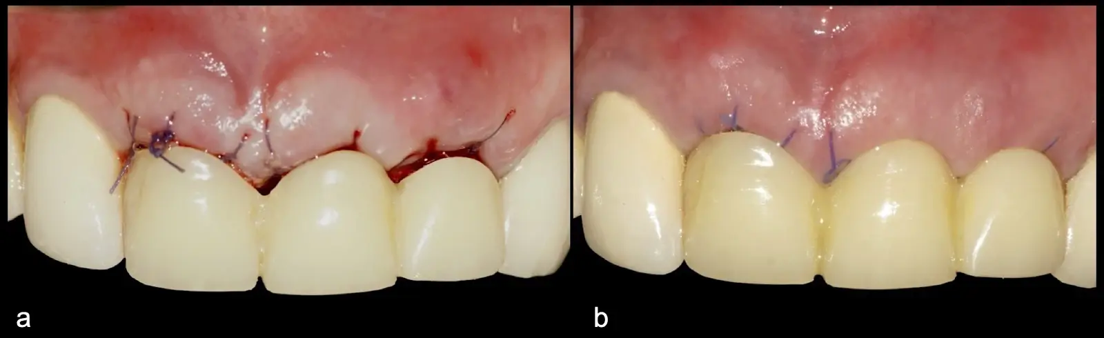 Post-surgical frontal view with a removable provisional prosthesis (a). Follow-up on day seven showing favourable healing attributed to ovate pontic provisionals, preservation of the papillary contours, and overall positive tissue response (b). Post-surgical frontal view with a removable provisional prosthesis (a). Follow-up on day seven showing favourable healing attributed to ovate pontic provisionals, preservation of the papillary contours, and overall positive tissue response (b).