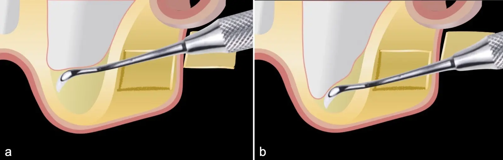 Desplazamiento de la membrana con curetas manuales  Desplazamiento de la membrana con curetas manuales
