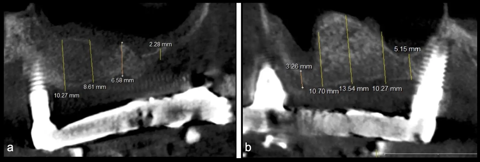 Control tomográfico post operatorio: corte sagital de ambos senos maxilares. (derecha e izquierda). Control tomográfico post operatorio: corte sagital de ambos senos maxilares. (derecha e izquierda).
