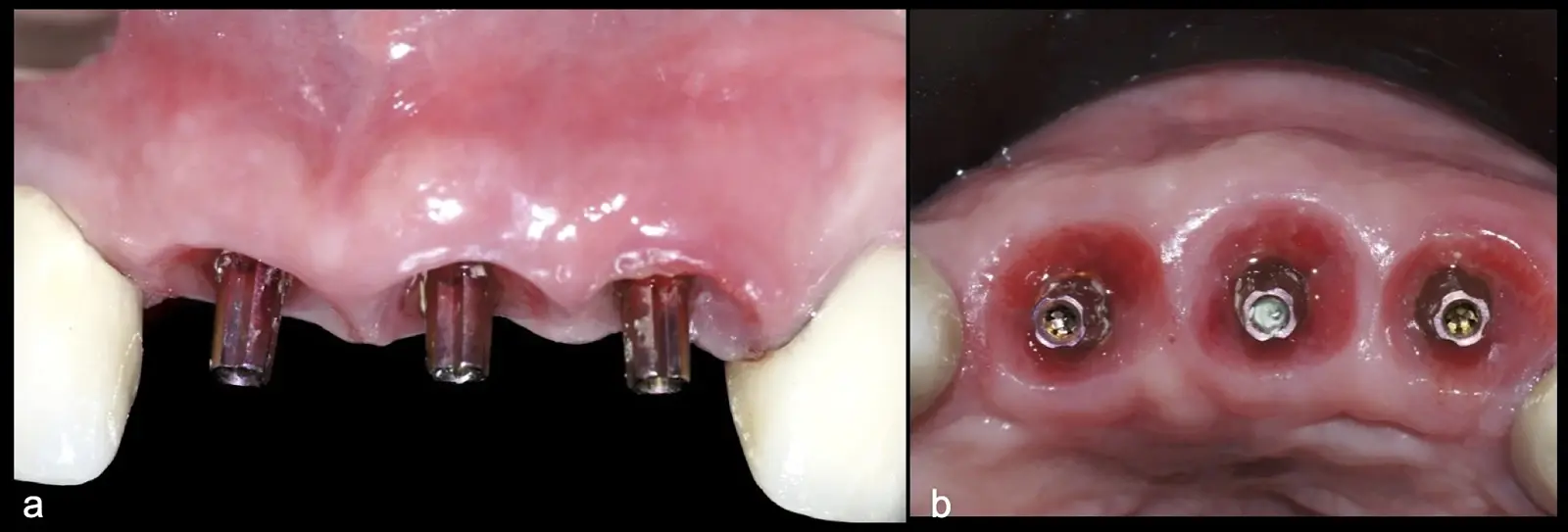 Universal abutments placed at the fourth month of the osseointegration period (a). Preservation of the papillary heights is also evident. Occlusal view showing peri-implant tissue health, with the creation of appropriate emergence profiles and preservation of the alveolar ridge contour (b). Universal abutments placed at the fourth month of the osseointegration period (a). Preservation of the papillary heights is also evident. Occlusal view showing peri-implant tissue health, with the creation of appropriate emergence profiles and preservation of the alveolar ridge contour (b).