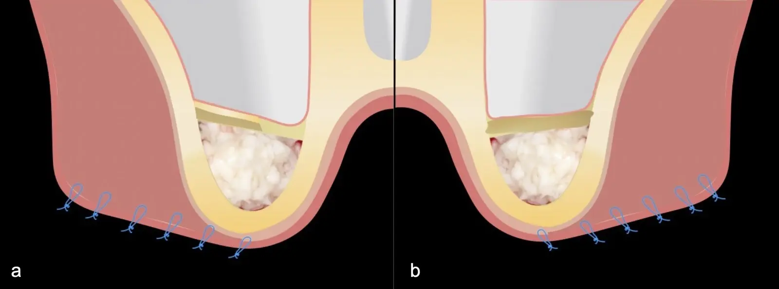 Reposicionamiento del colgajo y sutura Reposicionamiento del colgajo y sutura
