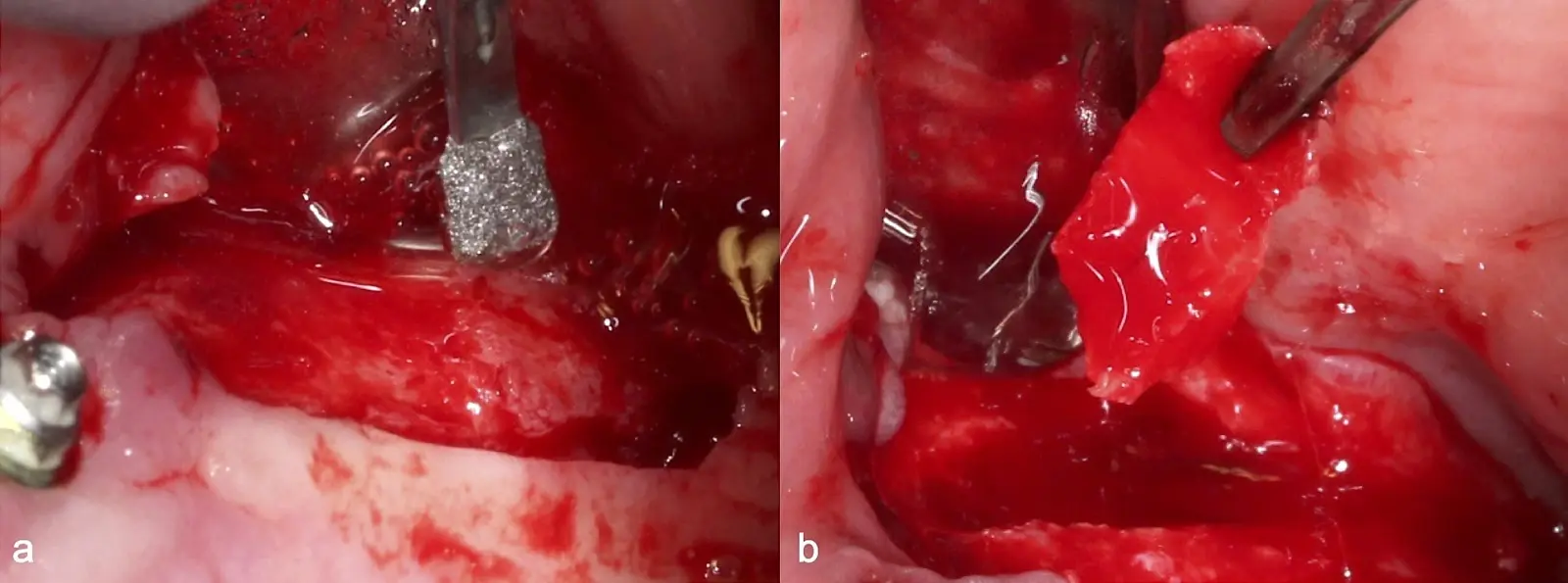 Delimitación y osteotomía por desgaste de la ventana lateral con el inserto plano de punta diamantada Delimitación y osteotomía por desgaste de la ventana lateral con el inserto plano de punta diamantada