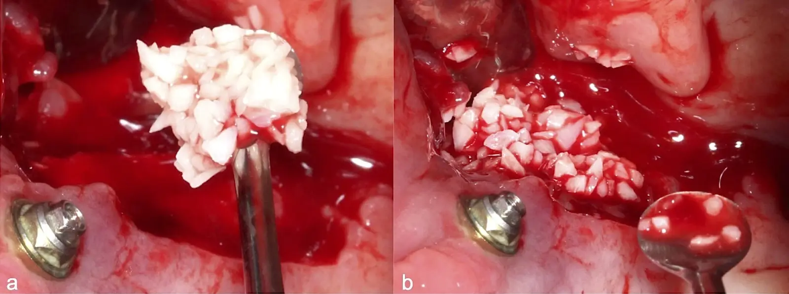 Colocación del material de relleno óseo dentro del seno maxilar Colocación del material de relleno óseo dentro del seno maxilar