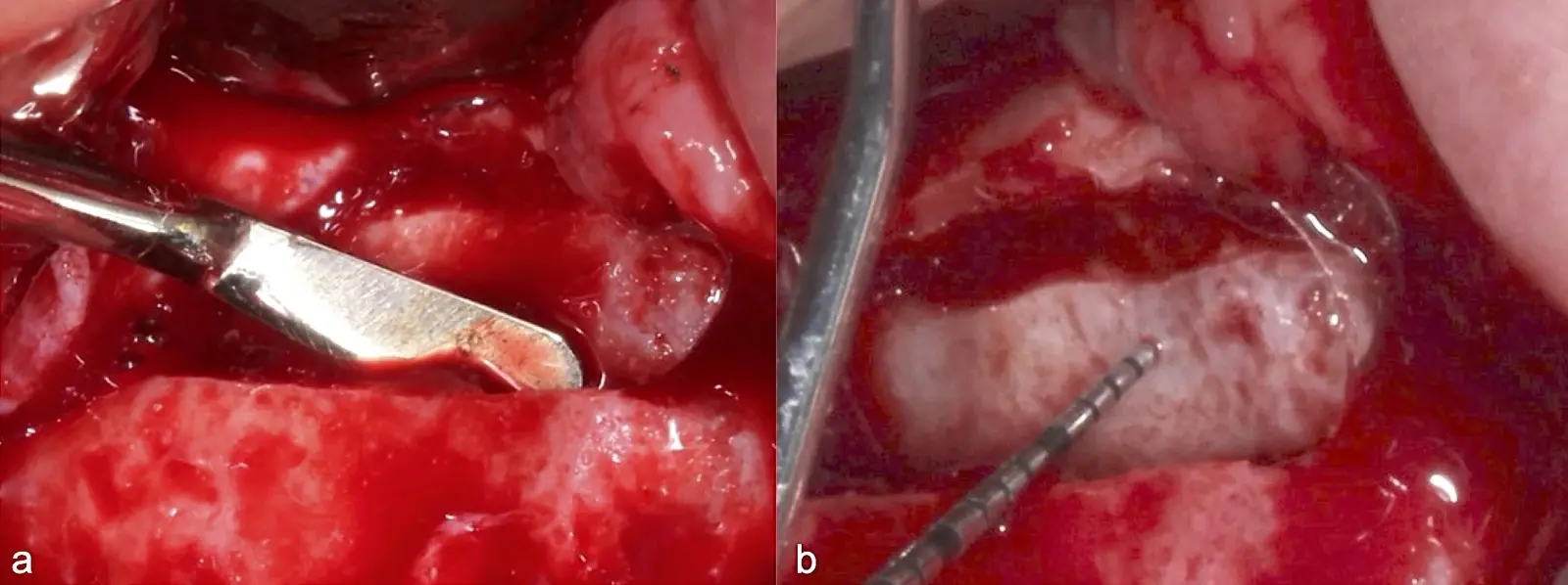 Decolado de la membrana de Schneider hasta la pared medial del seno maxilar Decolado de la membrana de Schneider hasta la pared medial del seno maxilar