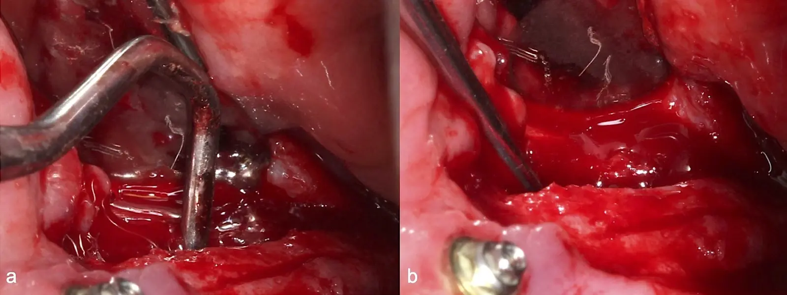 Elevación de la membrana de Schneider con curetas manuales  Elevación de la membrana de Schneider con curetas manuales