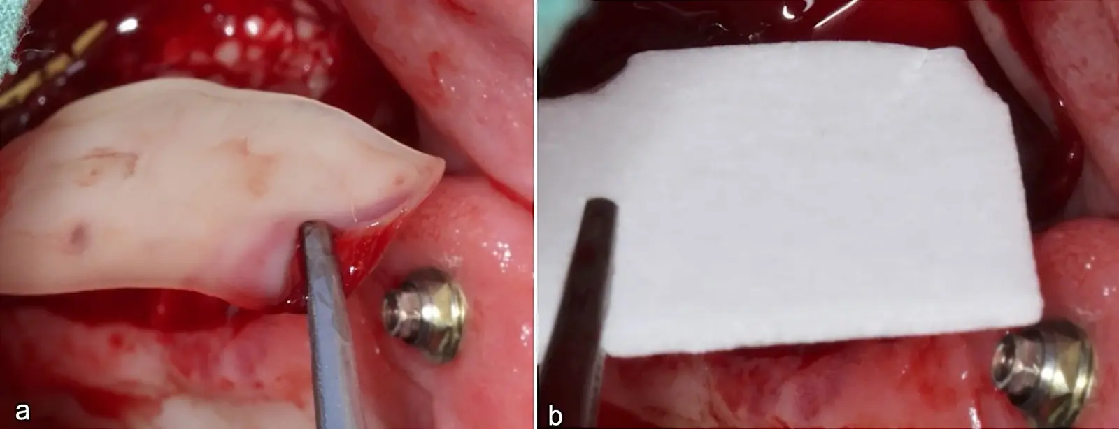 Membrana de A-PRF posicionada por encima del biomaterial óseo (a). Membrana de colágeno de reabsorción lenta posicionada sobre la membrana de A-PRF Membrana de A-PRF posicionada por encima del biomaterial óseo (a). Membrana de colágeno de reabsorción lenta posicionada sobre la membrana de A-PRF