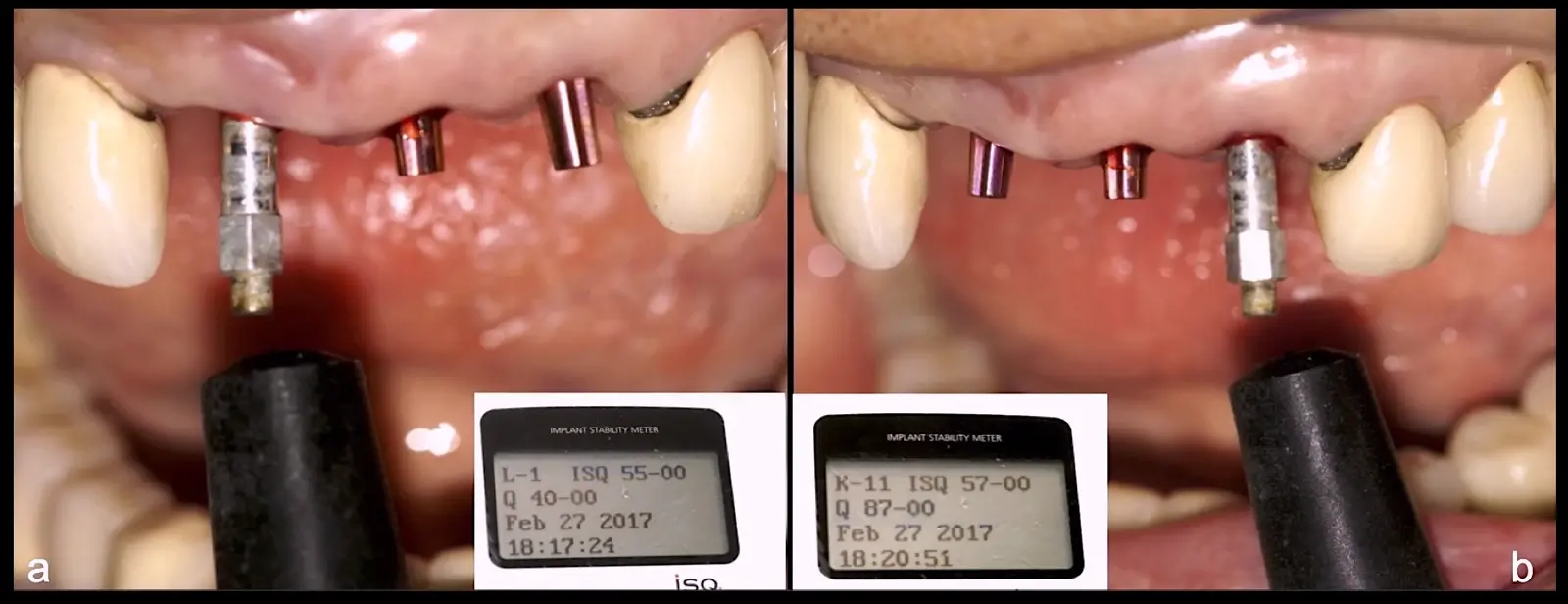 Implant stability measurements using resonance frequency analysis. ISQ values ranged between 55 and 57, indicating that further mineralisation of the peri-implant bone matrix is required (a, b). Implant stability measurements using resonance frequency analysis. ISQ values ranged between 55 and 57, indicating that further mineralisation of the peri-implant bone matrix is required (a, b).