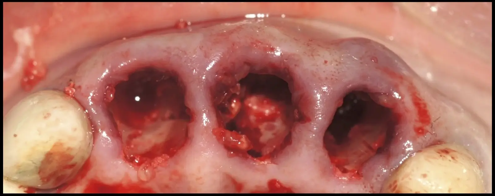 Post-extraction sockets of teeth 1.1, 2.1, and 2.2 demonstrating the absence of buccal bone plates. Post-extraction sockets of teeth 1.1, 2.1, and 2.2 demonstrating the absence of buccal bone plates.
