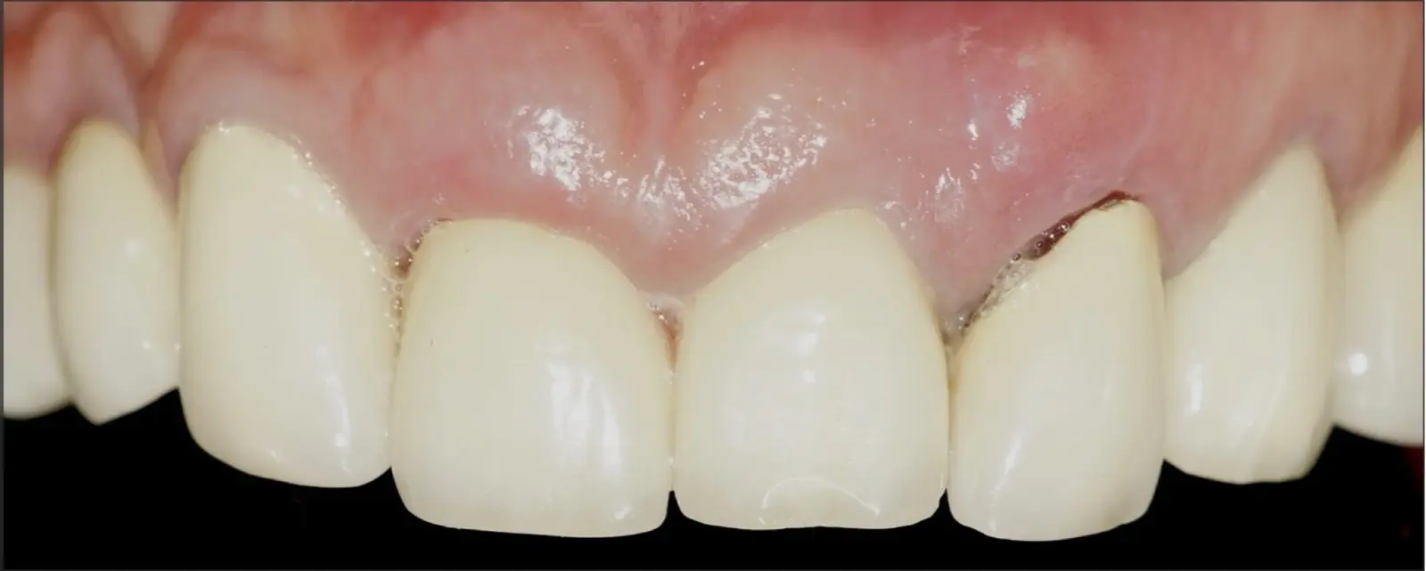 Frontal view of teeth 1.1, 2.1, and 2.2 showing root fracture diagnosis. Note the gingival contour disharmony, altered incisal plane, favourable amount of keratinised gingiva, and an apparently thick biotype. Frontal view of teeth 1.1, 2.1, and 2.2 showing root fracture diagnosis. Note the gingival contour disharmony, altered incisal plane, favourable amount of keratinised gingiva, and an apparently thick biotype.