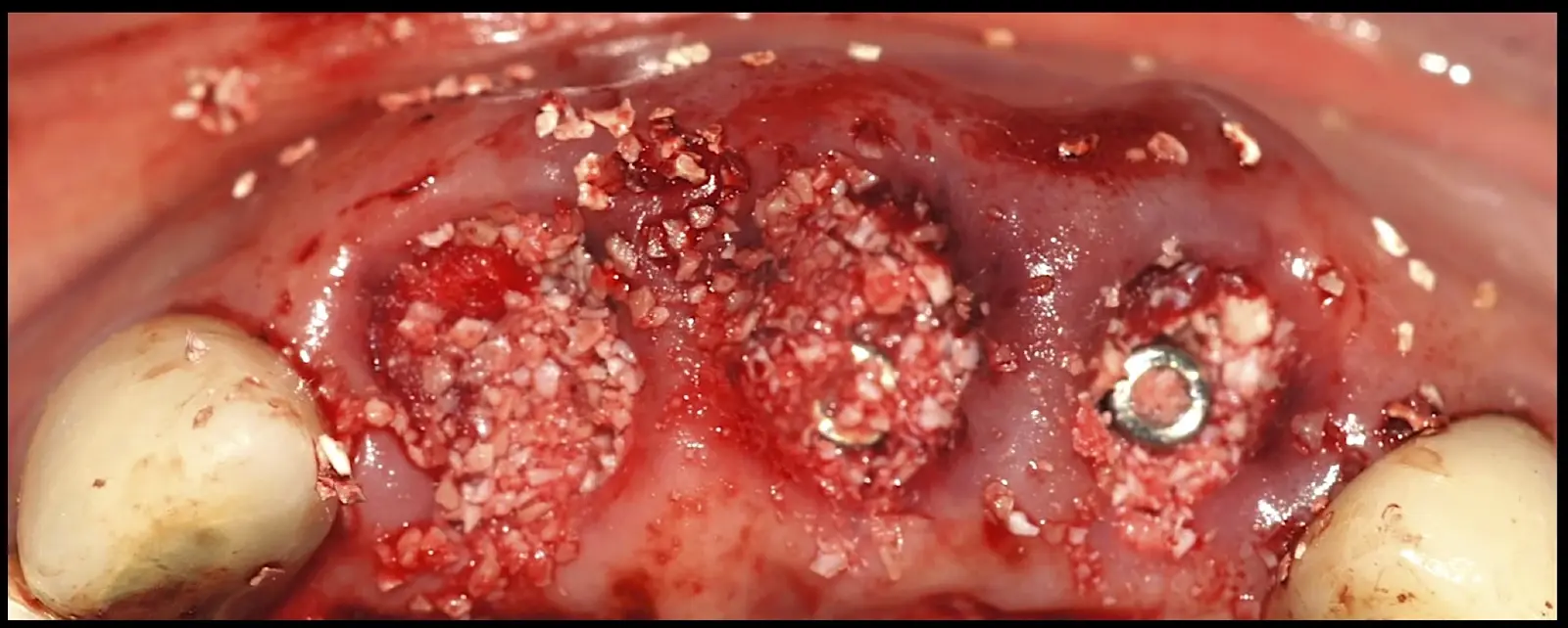 Occlusal view of the placed implants and compaction of the bone graft material around the implants. Occlusal view of the placed implants and compaction of the bone graft material around the implants.