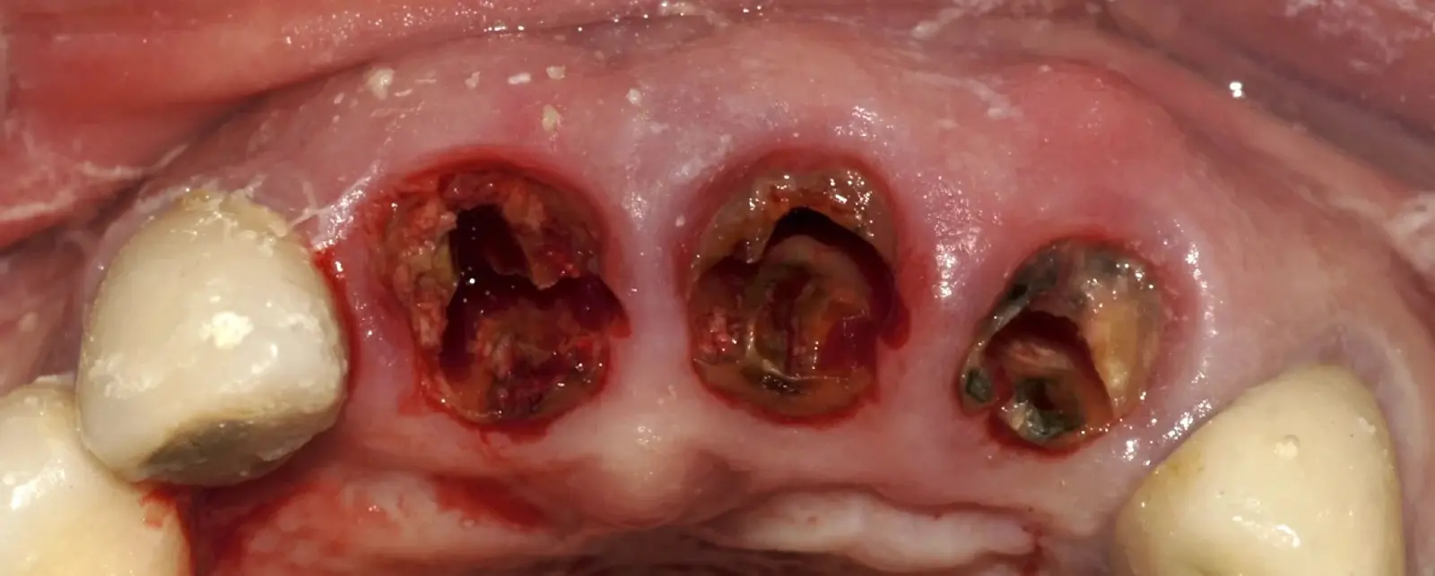 Occlusal view of the mesiodistal cuts of the root remnants. Occlusal view of the mesiodistal cuts of the root remnants.