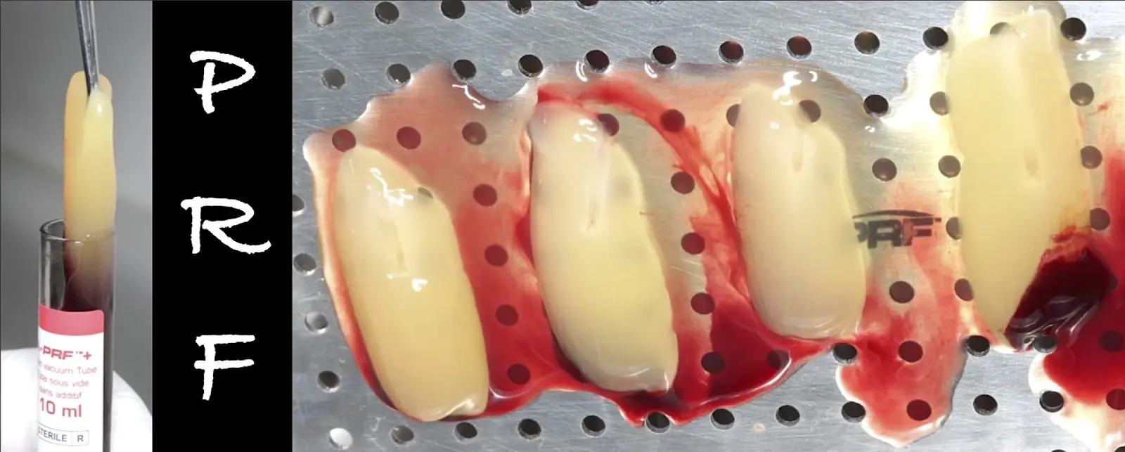 Membranas de A-PRF, obtenidas por centrifugado de la sangre del paciente a 1300 revoluciones/min, durante 8 minutos Membranas de A-PRF, obtenidas por centrifugado de la sangre del paciente a 1300 revoluciones/min, durante 8 minutos