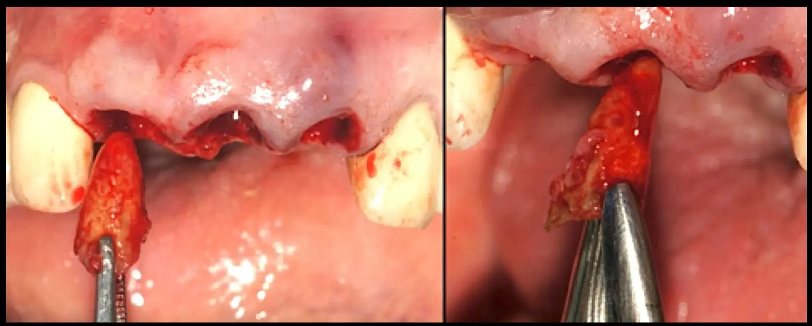 Extraction of the buccal fragments by displacing the remnants into the spaces created by the removal of the palatal fragments (a, b). Extraction of the buccal fragments by displacing the remnants into the spaces created by the removal of the palatal fragments (a, b).