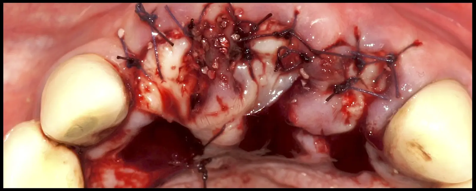 Primary closure achieved by rotating a pedicled palatal flap towards the buccal aspect and suturing with 4/0 polyglycolic acid sutures, combined with secondary intention healing of the denuded area, while preserving the integrity of the gingival papillae. Primary closure achieved by rotating a pedicled palatal flap towards the buccal aspect and suturing with 4/0 polyglycolic acid sutures, combined with secondary intention healing of the denuded area, while preserving the integrity of the gingival papillae.