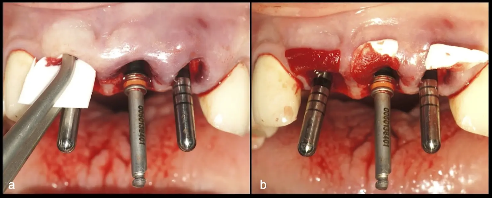 Following the preparation of the implant beds, parallelism pins were inserted to occlude the prepared sites, thereby facilitating the placement of bone graft material. Subsequently, resorbable membranes were positioned within the alveolus using the cone technique (a, b). Following the preparation of the implant beds, parallelism pins were inserted to occlude the prepared sites, thereby facilitating the placement of bone graft material. Subsequently, resorbable membranes were positioned within the alveolus using the cone technique (a, b).