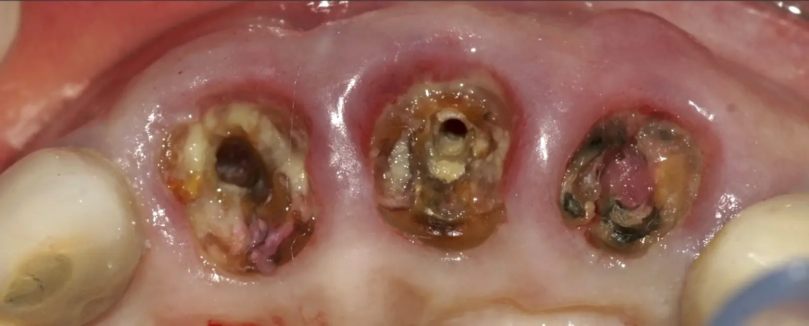 Occlusal view: demonstrating preserved gingival contour. Occlusal view: demonstrating preserved gingival contour.
