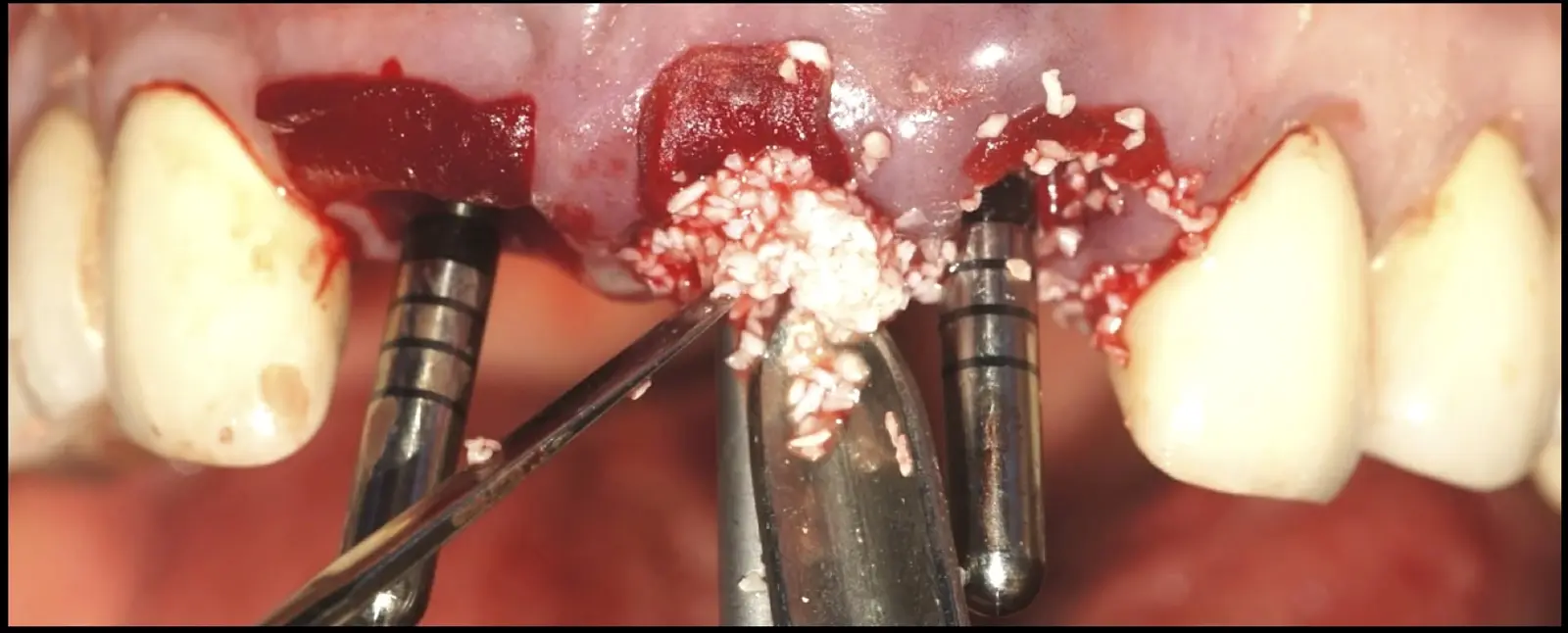 Placement of bovine bone biomaterial in the space delineated by the parallelism pin and the membrane. It is noteworthy that a larger residual space, correlates with a thicker newly formed buccal bone plate. Placement of bovine bone biomaterial in the space delineated by the parallelism pin and the membrane. It is noteworthy that a larger residual space, correlates with a thicker newly formed buccal bone plate.