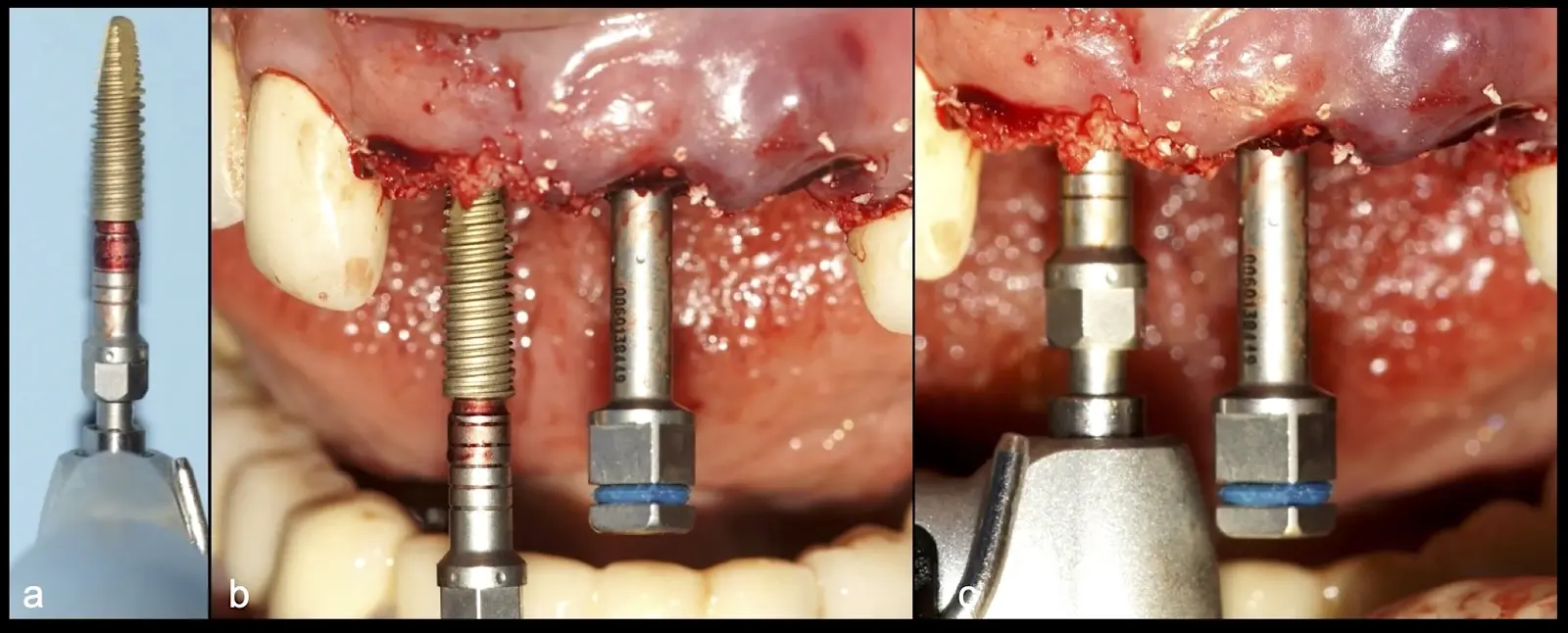 Occlusal view of the alveolar sockets filled with compacted biomaterial. Occlusal view of the alveolar sockets filled with compacted biomaterial.