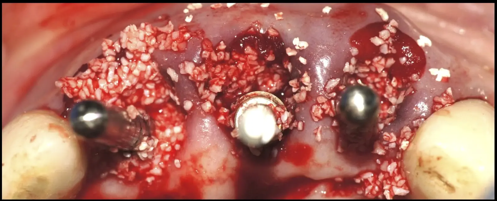 Removal of the parallelism pins and placement of 3.5 mm diameter × 11.5 mm length nanotechnology implants (Unitite, S.I.N., Brazil), positioned subcrestally, maintaining a 3 mm inter-platform spacing to preserve the integrity of the bone crests and interdental papillae. Removal of the parallelism pins and placement of 3.5 mm diameter × 11.5 mm length nanotechnology implants (Unitite, S.I.N., Brazil), positioned subcrestally, maintaining a 3 mm inter-platform spacing to preserve the integrity of the bone crests and interdental papillae.