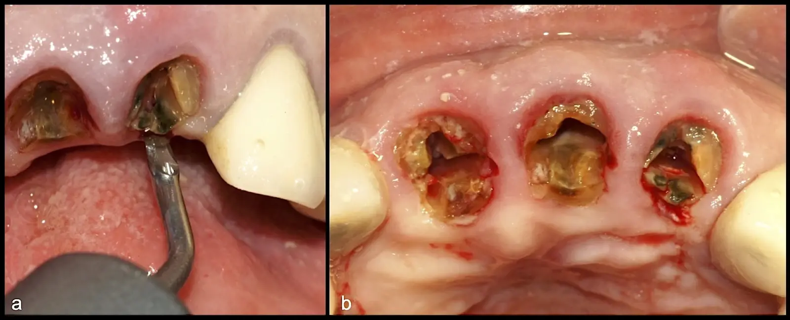 Syndesmotomy using the piezoelectric periotome (EX1 by W&H) (a), positioned in the periodontal ligament space at the level of the palatal fragments (b). Syndesmotomy using the piezoelectric periotome (EX1 by W&H) (a), positioned in the periodontal ligament space at the level of the palatal fragments (b).