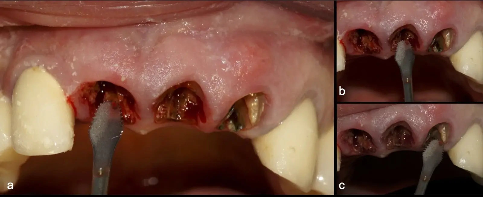Initial mesiodistal root hemisection to a depth of approximately 10 mm in teeth 1.1, 2.1, and 2.2 using a flat serrated piezo instrument (B6 by W&H), taking care to avoid damage to the proximal bone crests (a, b, c). Initial mesiodistal root hemisection to a depth of approximately 10 mm in teeth 1.1, 2.1, and 2.2 using a flat serrated piezo instrument (B6 by W&H), taking care to avoid damage to the proximal bone crests (a, b, c).