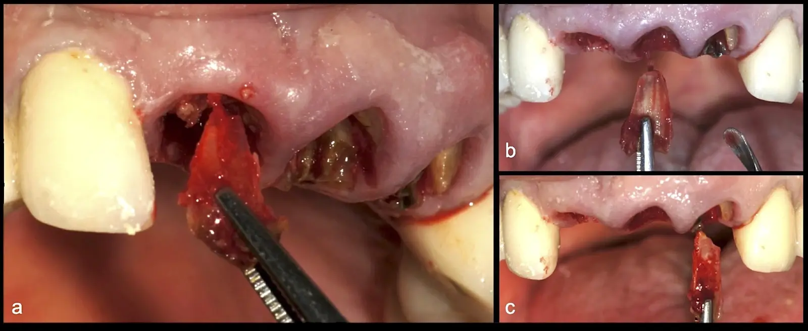Extraction of the palatal fragments of teeth 1.1, 2.1, and 2.2 due to the greater thickness of the palatal bone plate (a, b, c). Extraction of the palatal fragments of teeth 1.1, 2.1, and 2.2 due to the greater thickness of the palatal bone plate (a, b, c).