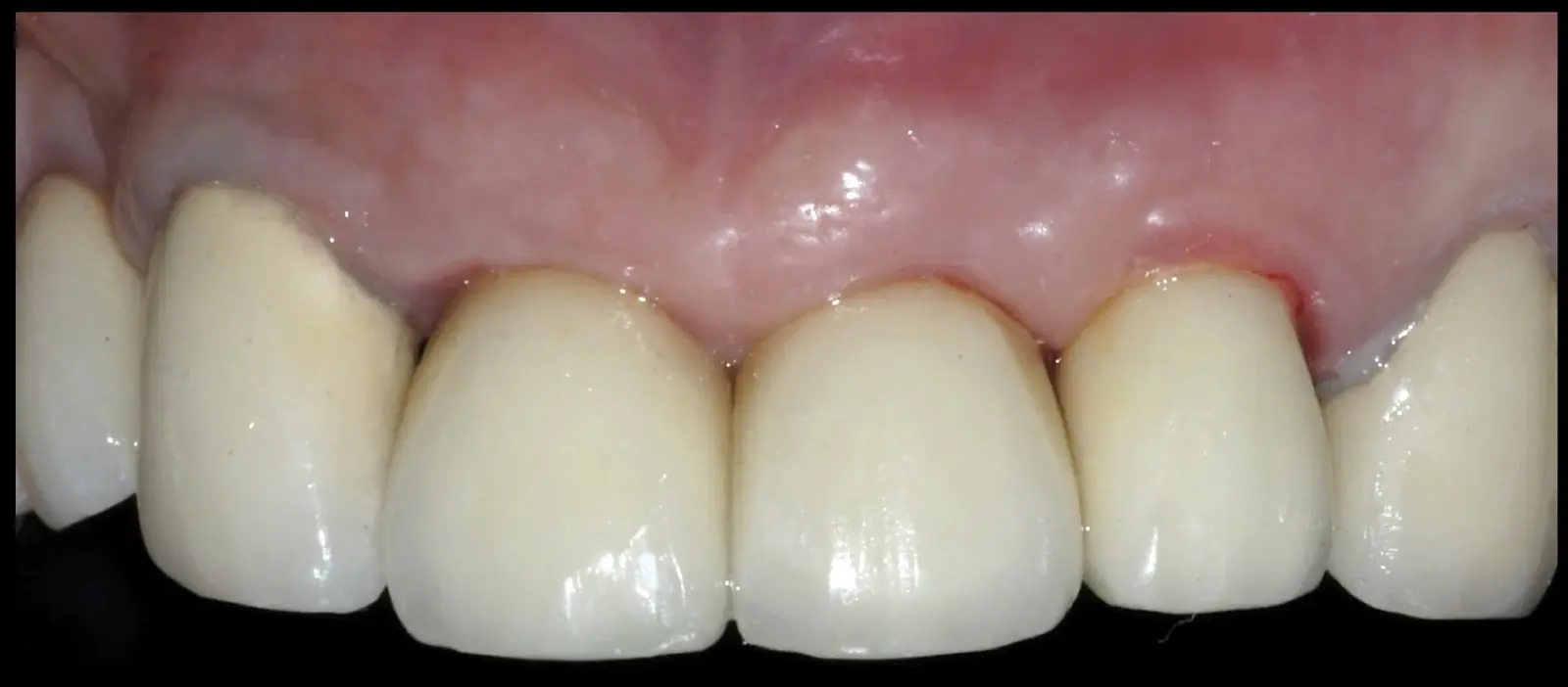 Abgeschlossener Fall unter Erhalt der Kontur des Alveolarkamms, der gingivalen Kontur und der Papillenhöhe. Abgeschlossener Fall unter Erhalt der Kontur des Alveolarkamms, der gingivalen Kontur und der Papillenhöhe.