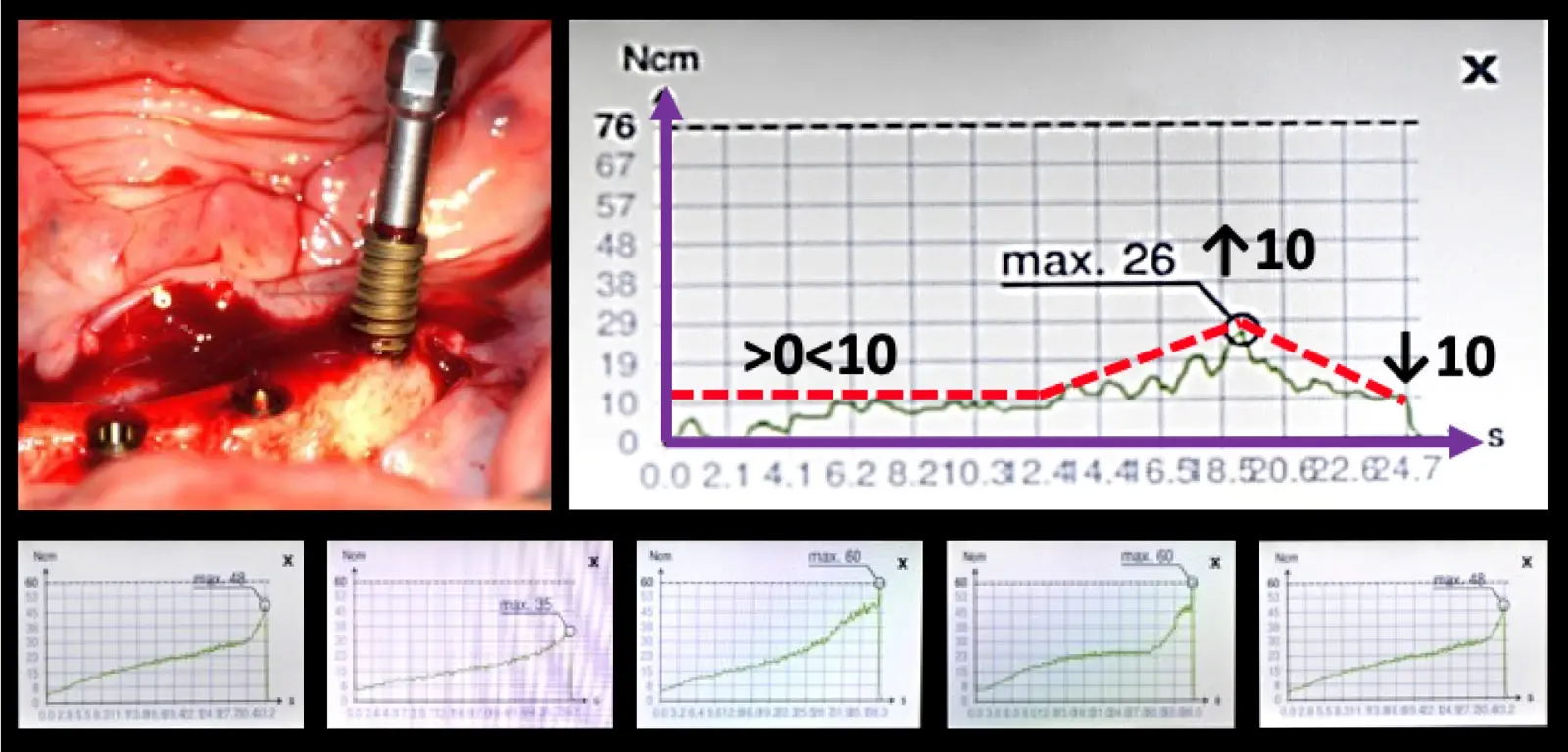 Evaluación de la curva de torque de inserción Evaluación de la curva de torque de inserción