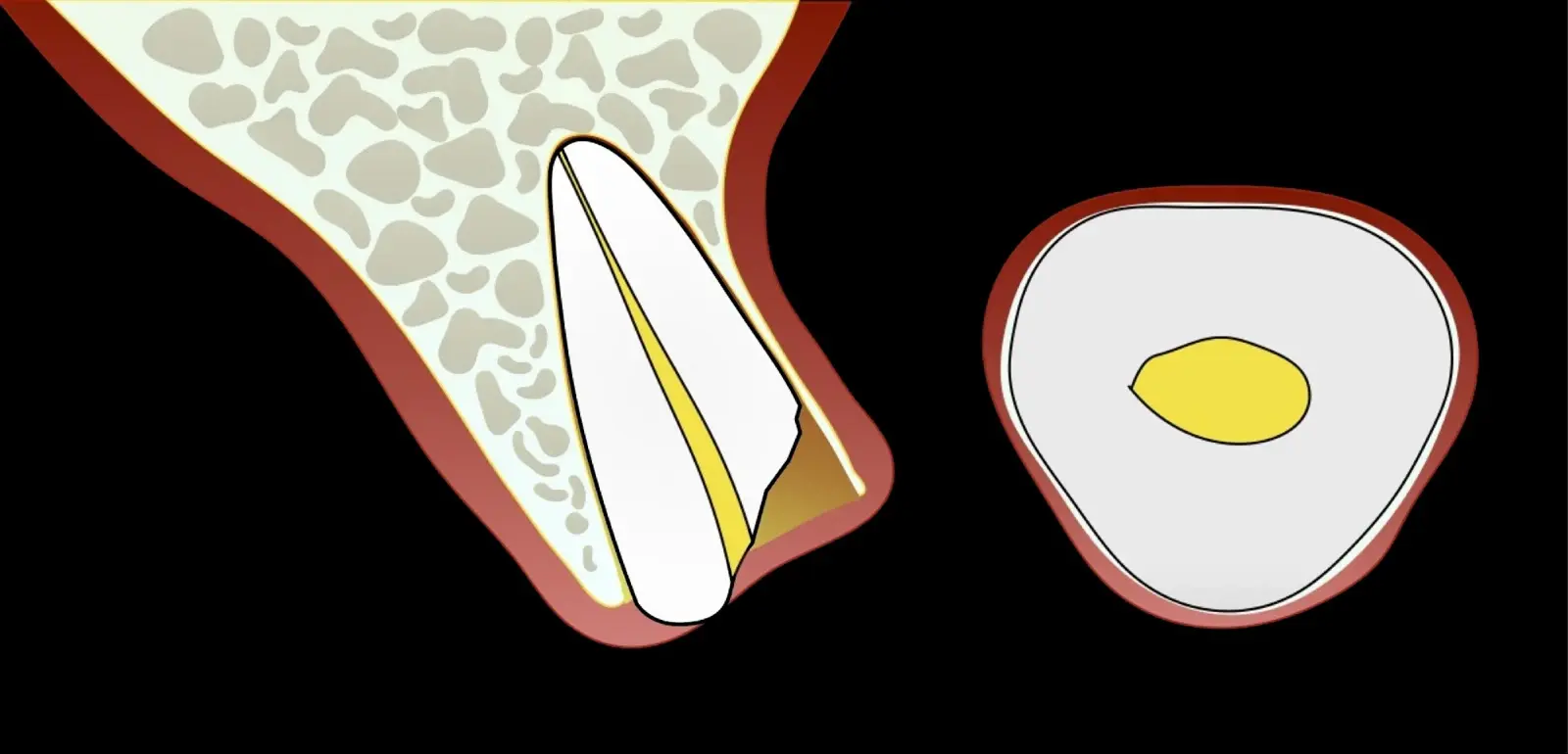 Single-rooted tooth remnant with extensive coronal destruction and a subcrestal fracture. Single-rooted tooth remnant with extensive coronal destruction and a subcrestal fracture.