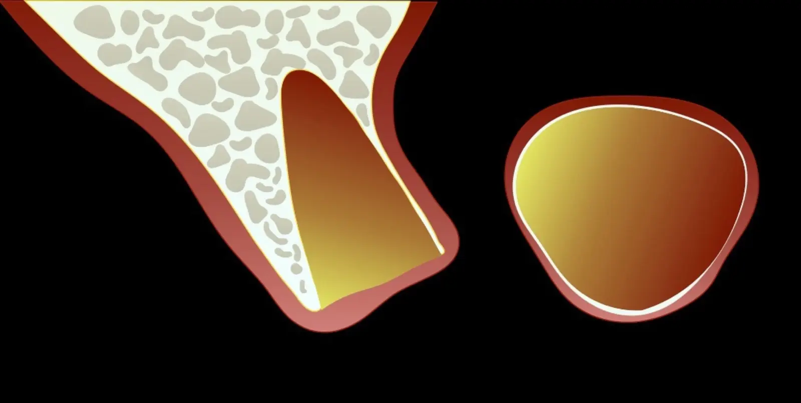 Completion of atraumatic tooth extraction with preservation of the bony plates and alveolar ridge. Completion of atraumatic tooth extraction with preservation of the bony plates and alveolar ridge.