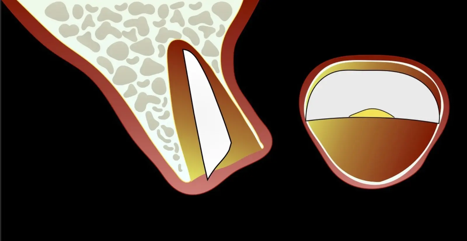 Verlagerung des vestibulären Fragments in den palatinalen Raum der Alveole. Verlagerung des vestibulären Fragments in den palatinalen Raum der Alveole.