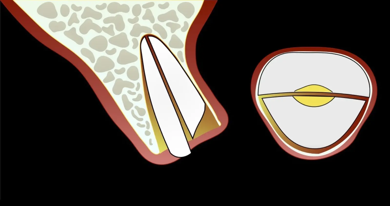 Displacement of the palatal fragment. Displacement of the palatal fragment.