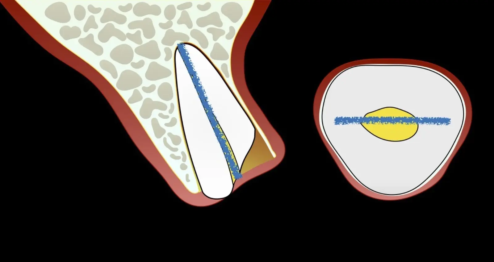Mesio-distales Odontosektionsdesign mit langstieligem Schneideinstrument oder Bohrer. Mesio-distales Odontosektionsdesign mit langstieligem Schneideinstrument oder Bohrer.