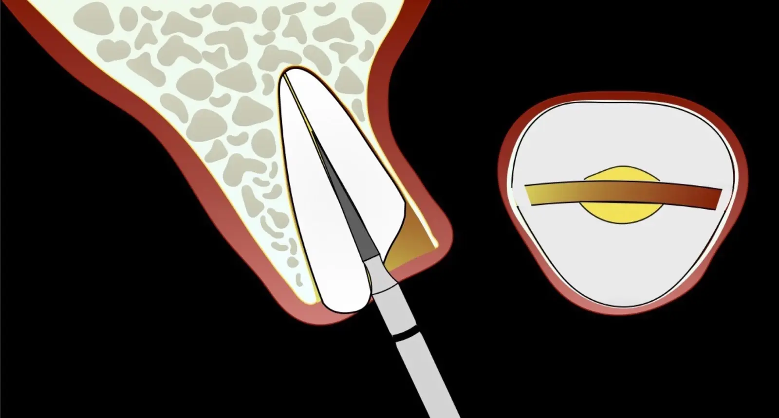 Initiation of the odontosection emplying a rotary instrument. Initiation of the odontosection emplying a rotary instrument.