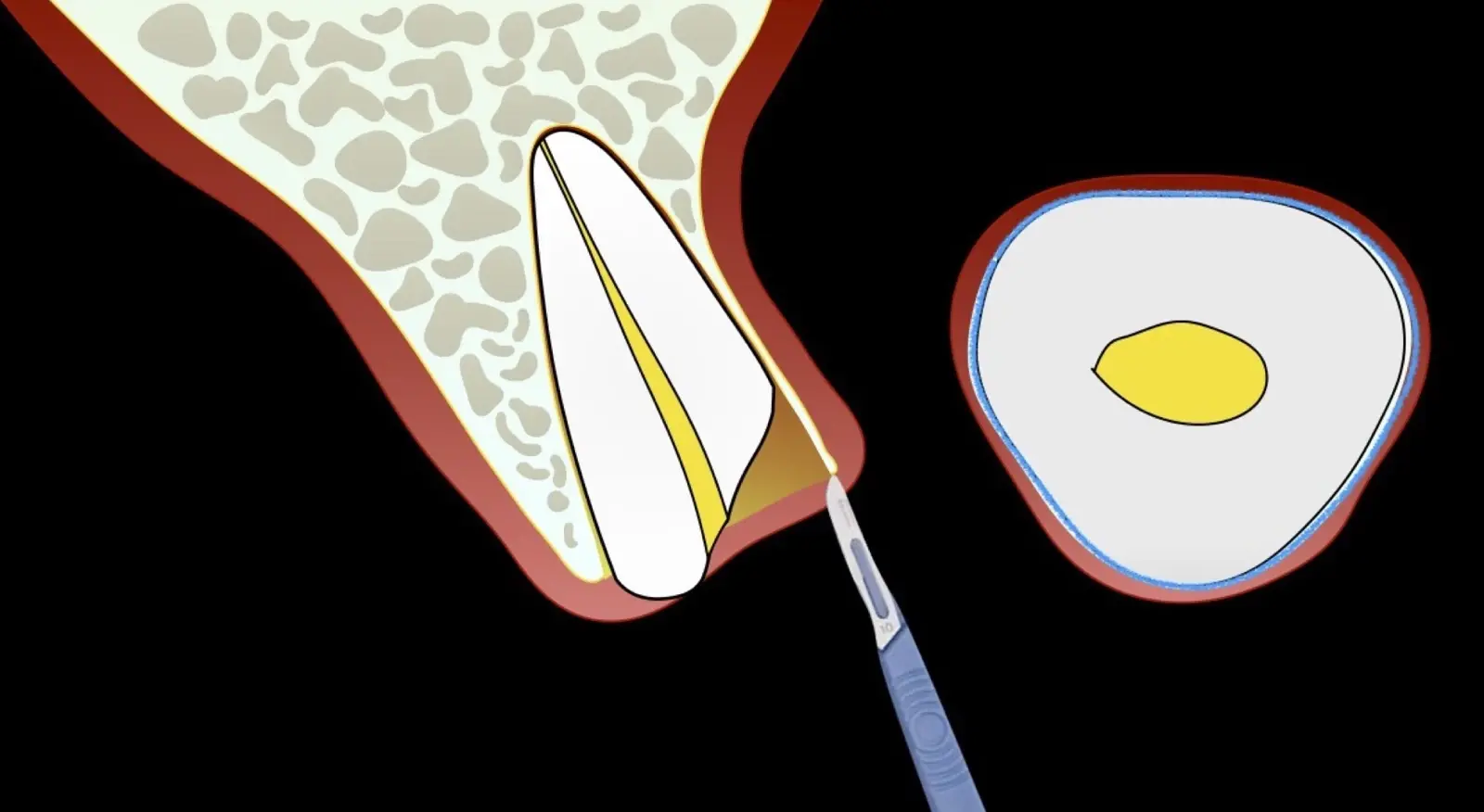 Intrasulcular incision around the entire tooth. Intrasulcular incision around the entire tooth.