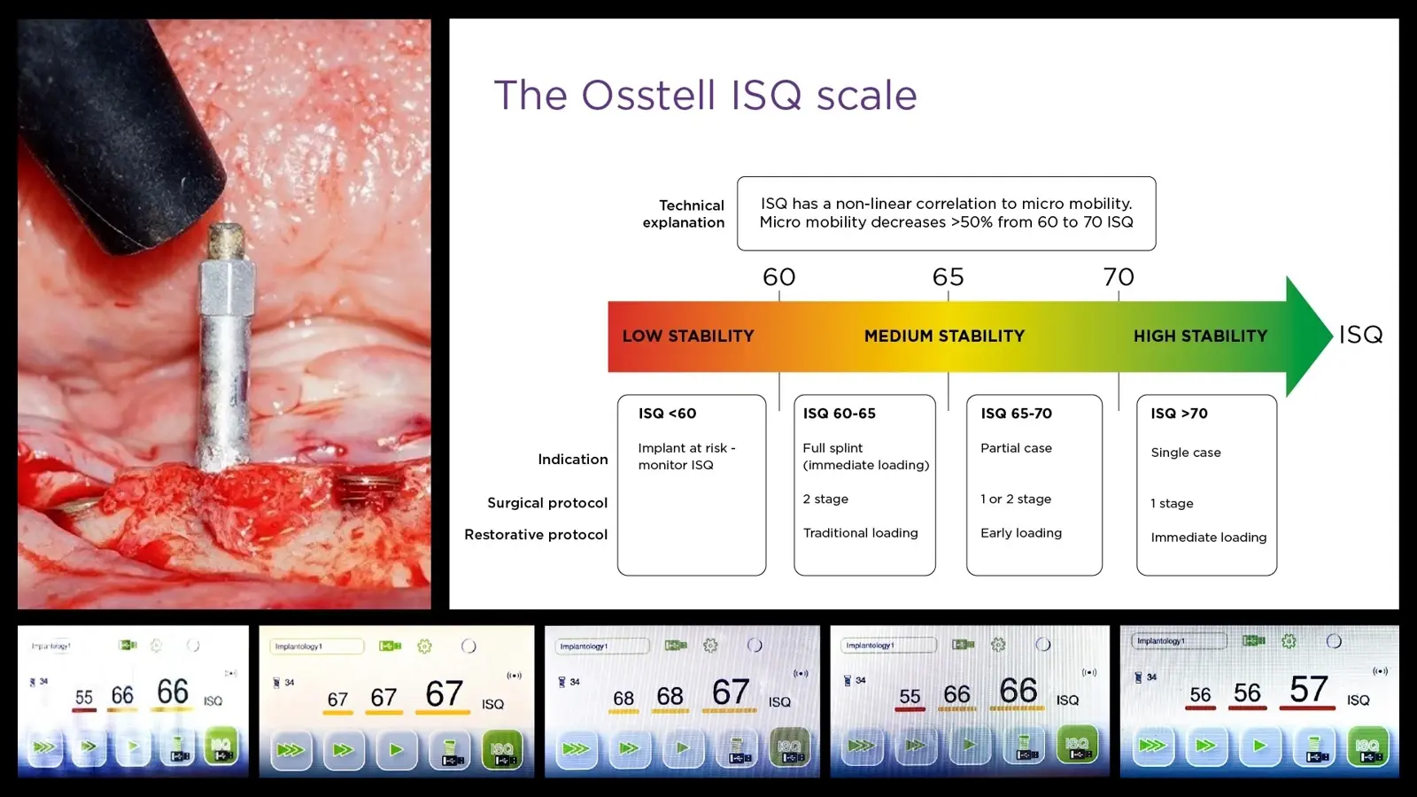 Análisis de la estabilidad primaria Análisis de la estabilidad primaria
