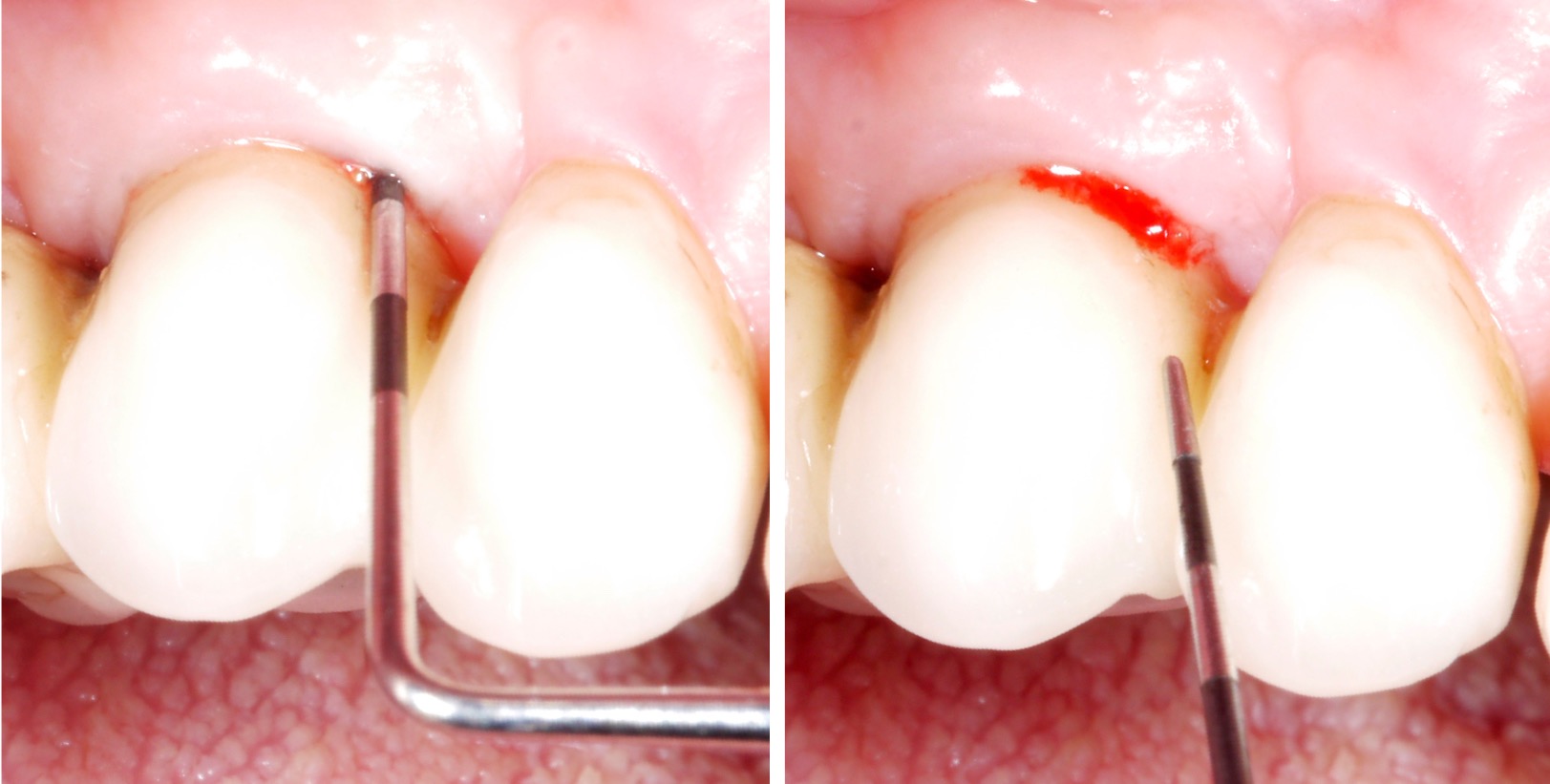 Untreated peri-implant mucositis… Untreated peri-implant mucositis…