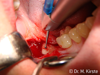 Exemple patient W&H Exemple patient W&H