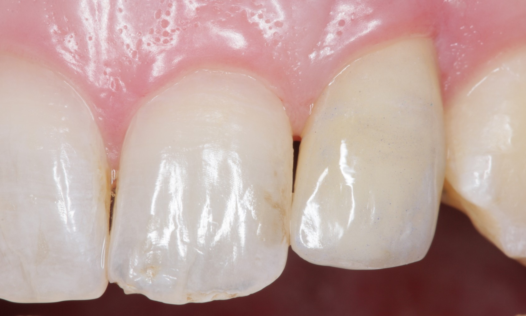 The patient has their new implant-supported prosthesis – what now? The patient has their new implant-supported prosthesis – what now?