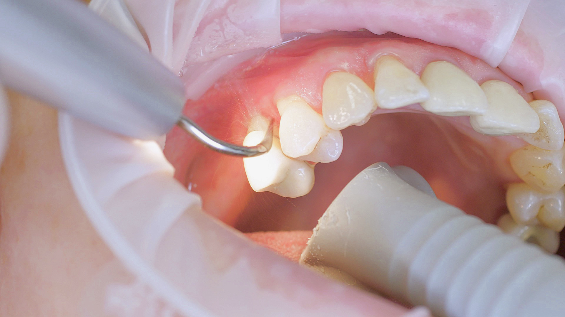 An air scaler efficiently performs the initial debridement An air scaler efficiently performs the initial debridement