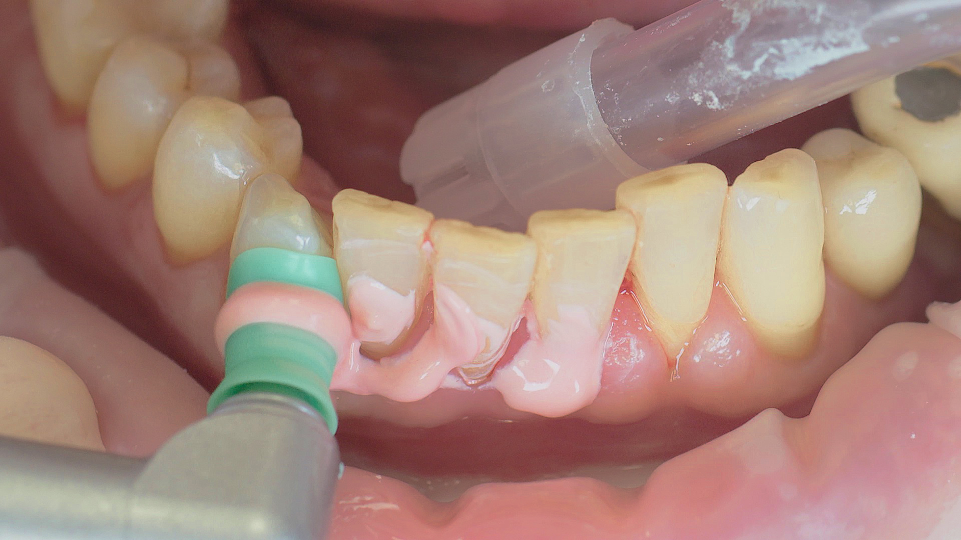 Good individual oral hygiene and professional biofilm management Good individual oral hygiene and professional biofilm management