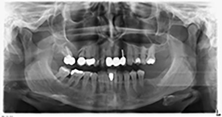 Orthopantomogramm mit Knochenabbau in Regio 16–14.  Orthopantomogramm mit Knochenabbau in Regio 16–14.