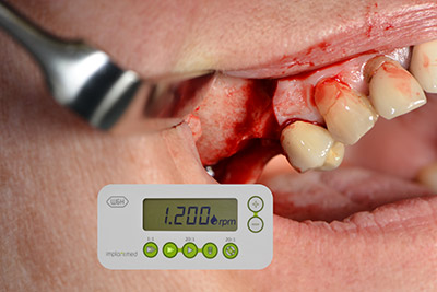 Пилотно изпиляване Пилотно изпиляване