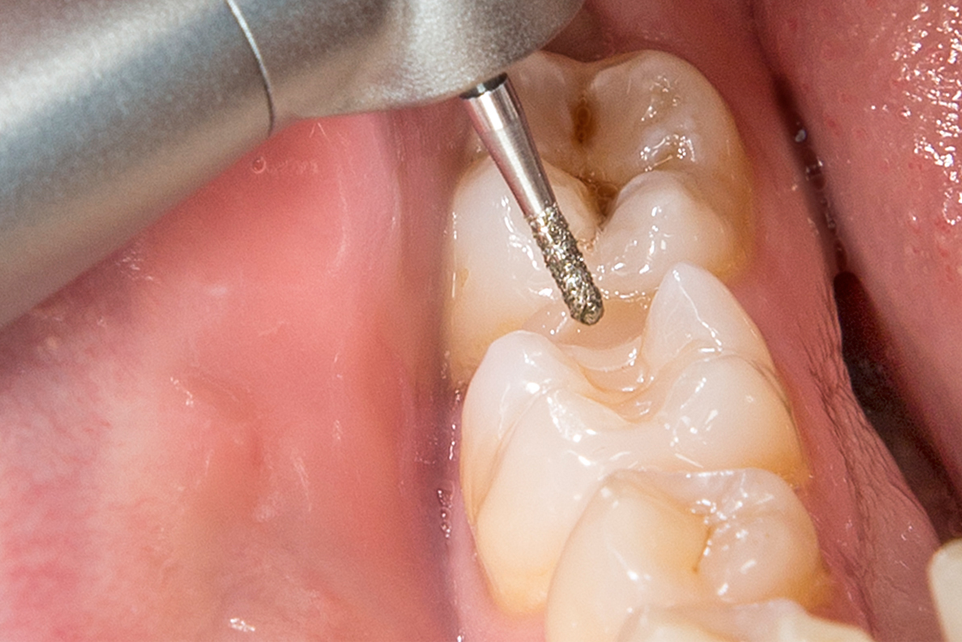Removal of fillings