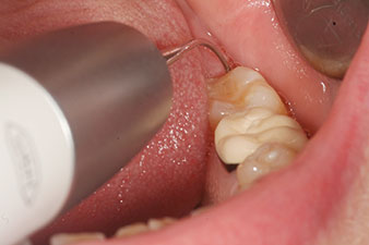 The tips 3Pr and 3Pl – simple subgingival access to periodontal pockets The tips 3Pr and 3Pl – simple subgingival access to periodontal pockets