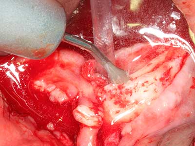 Piezo surgery Piezo surgery